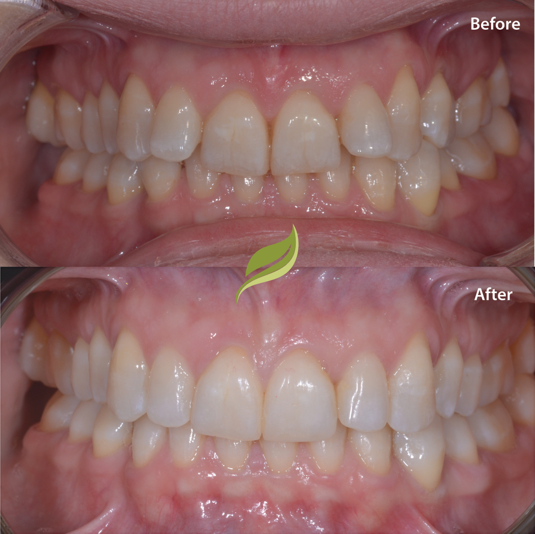 Teeth aligned with Invisalign, followed by teeth whitening and minor composite edge bonding...To book your free Invisalign consultation ...DM us or follow links in bio!​​​​​​​​
😁🦷 ​​​​​​​​
#veneers #invisalign #compositebonding #holmfirth