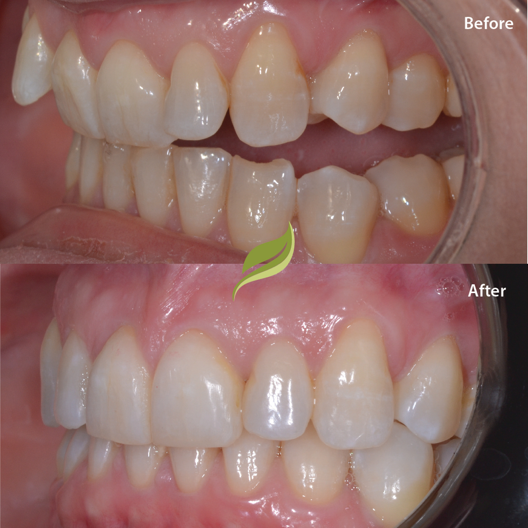 This patient was unhappy with the protruding lateral incisors and tipped back central incisors.​​​​​​​​
Teeth were aligned using Invisalign, finishing off with teeth whitening and minor composite edge bonding...for the perfect smile aesthetic!​​​​​​​​
To book your free Invisalign consultation ...DM us or follow the links in our bio!​​​​​​​​
😁🦷 ​​​​​​​​
​​​​​​​​
#veneers #invisalign #compositebonding #holmfirth