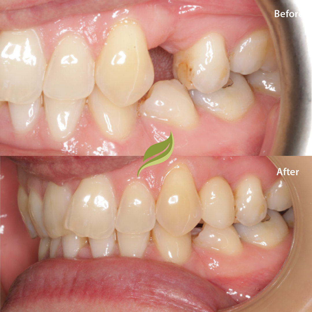 Dental Implants are a great option to replace fractured or missing teeth. ​​​​​​​​
To book your consultation ...DM us or follow the links in our bio!​​​​​​​​​​​​​​​​
😁🦷 ​​​​​​​​​​​​​​​​
​​​​​​​​​​​​​​​​
#dentalimplants #invisalign #compositebonding #holmfirth