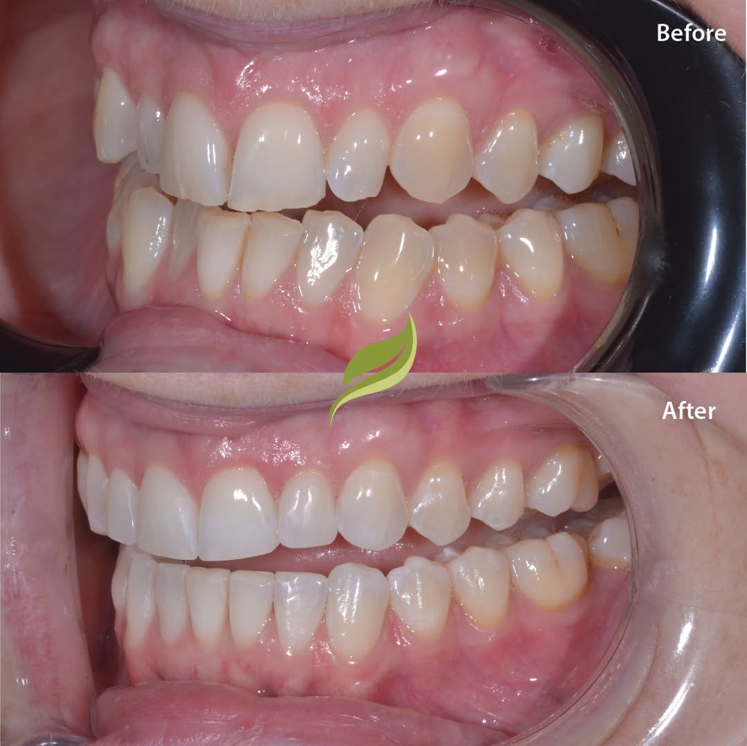 Teeth aligned with Invisalign, followed by teeth whitening and minor composite edge bonding...To book your free Invisalign consultation ...DM us or follow links in bio!​​​​​​​​​​​​​​​​
😁🦷 ​​​​​​​​​​​​​​​​
#veneers #invisalign #compositebonding #holmfirth