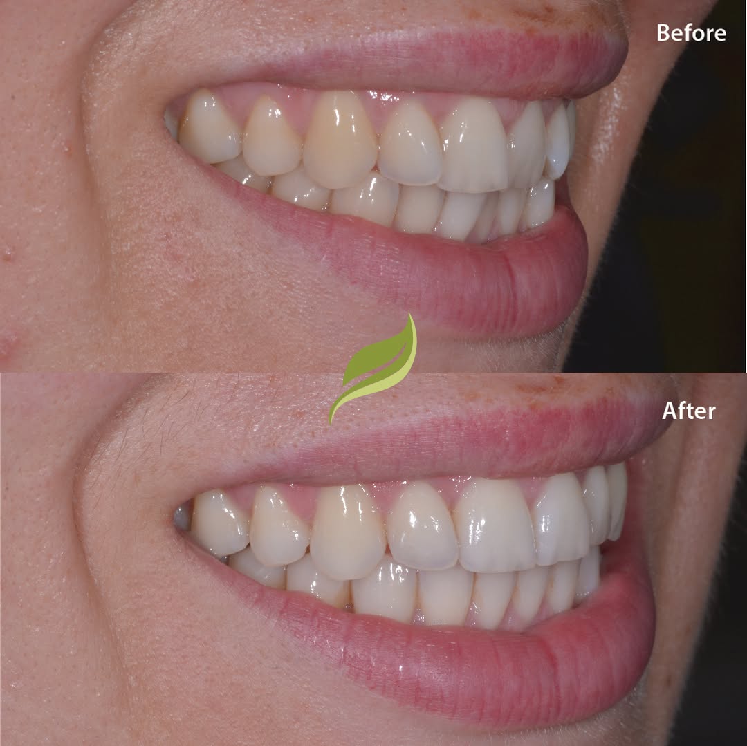 This patient was unhappy with the crowding/overlapping of her front teeth. ​​​​​​​​
Teeth were aligned using Invisalign, finishing off with teeth whitening and minor edge polishing!​​​​​​​​
To book your free Invisalign consultation ...DM us or follow the links in our bio!​​​​​​​​​​​​​​​​
😁🦷 ​​​​​​​​​​​​​​​​
​​​​​​​​​​​​​​​​
#veneers #invisalign #compositebonding #holmfirth