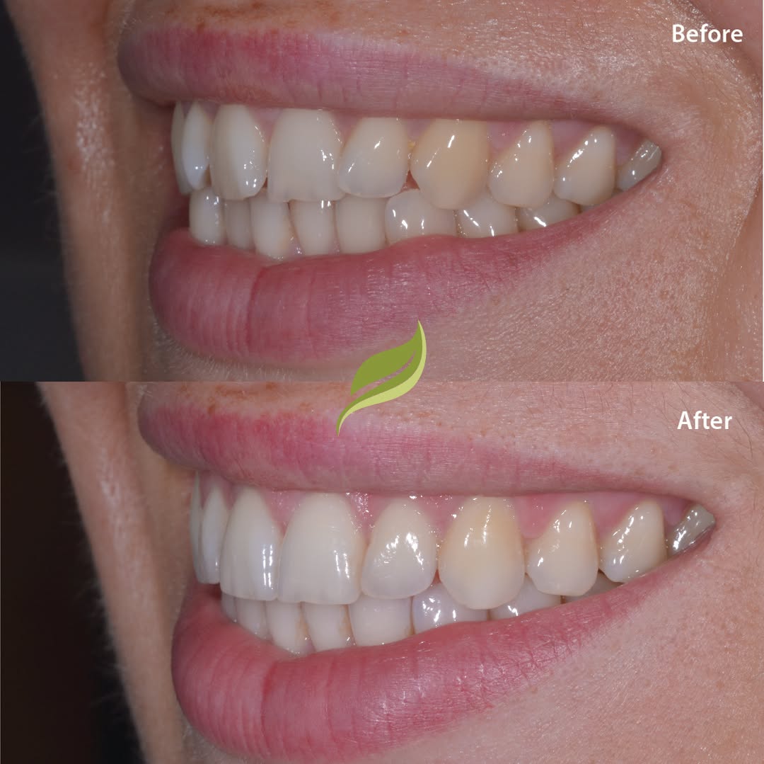 This patient was unhappy with the crowding/overlapping of her front teeth. ​​​​​​​​
Teeth were aligned using Invisalign, finishing off with teeth whitening and minor edge polishing!​​​​​​​​
To book your free Invisalign consultation ...DM us or follow the links in our bio!​​​​​​​​​​​​​​​​
😁🦷 ​​​​​​​​​​​​​​​​
​​​​​​​​​​​​​​​​
#veneers #invisalign #compositebonding #holmfirth