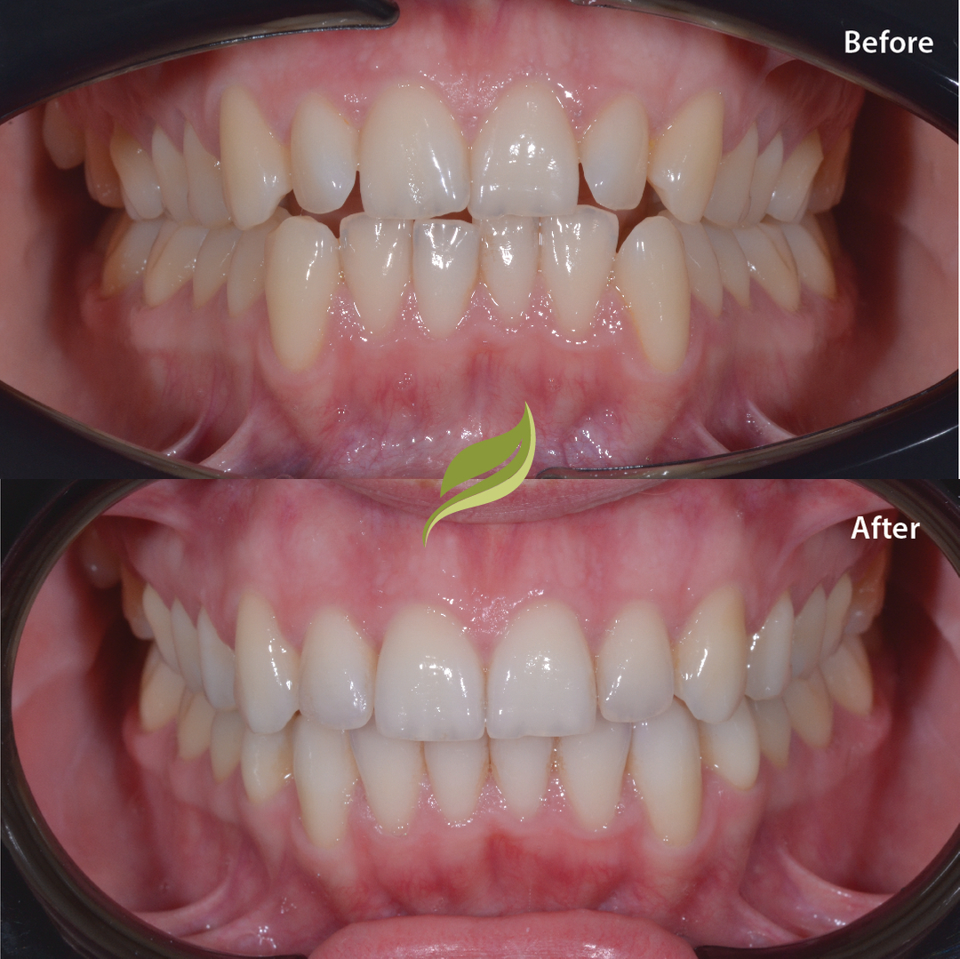 This patient was unhappy with the crowding/overlapping of her front teeth. ​​​​​​​​​​​​​​​​
Teeth were aligned using Invisalign, finishing off with teeth whitening and minor edge polishing!​​​​​​​​​​​​​​​​
To book your free Invisalign consultation ...DM us or follow the links in our bio!​​​​​​​​​​​​​​​​​​​​​​​​
😁🦷 ​​​​​​​​​​​​​​​​​​​​​​​​
​​​​​​​​​​​​​​​​​​​​​​​​
#veneers #invisalign #compositebonding #holmfirth