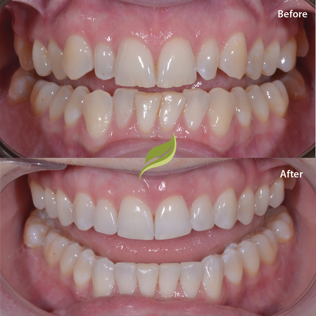 Teeth aligned with Invisalign, followed by teeth whitening and minor composite edge bonding...To book your free Invisalign consultation ...DM us or follow links in bio!​​​​​​​​​​​​​​​​
😁🦷 ​​​​​​​​​​​​​​​​
#veneers #invisalign #compositebonding #holmfirth