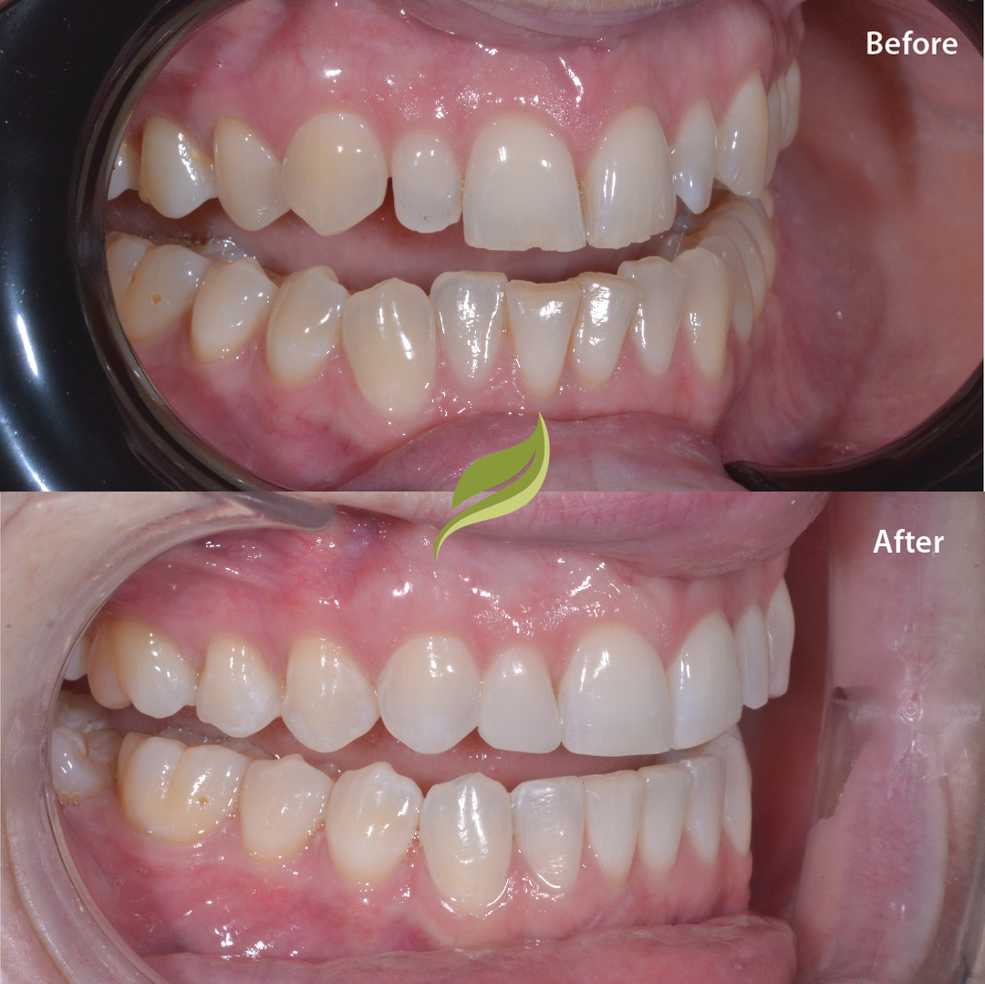 Teeth aligned with Invisalign, followed by teeth whitening and minor composite edge bonding...To book your free Invisalign consultation ...DM us or follow links in bio!​​​​​​​​​​​​​​​​​😁🦷 ​​​​​​​​
#veneers #invisalign #compositebonding #holmfirth