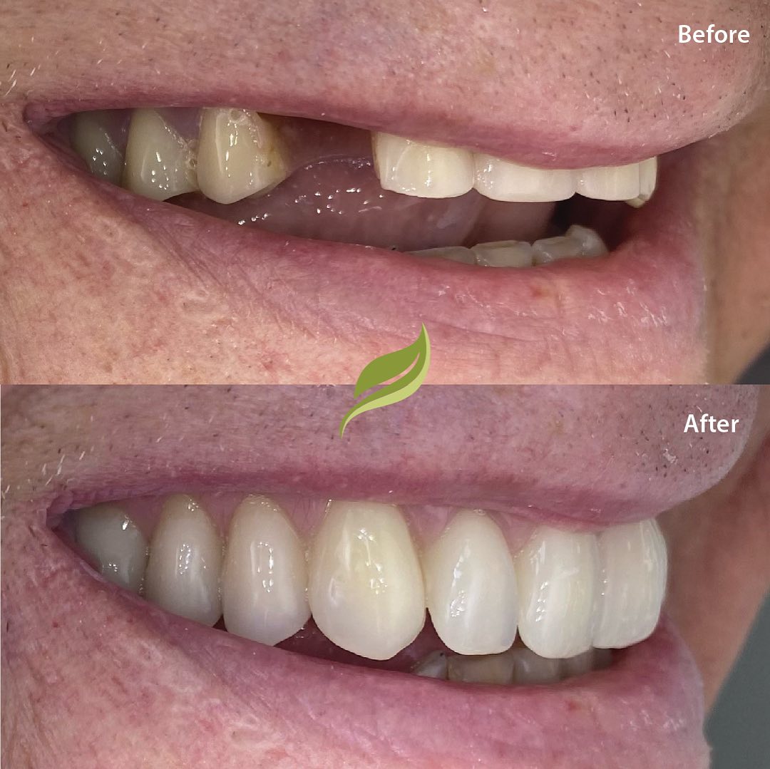 Natural denture smile makeover, yes they really are fake teeth!

The patient wanted longer natural looking teeth and was happy with the final result.

We carry out all treatments to replace missing teeth, get in touch if interested.

#dentistry #denture #smile #stablecourtdentalsurgery #chrome