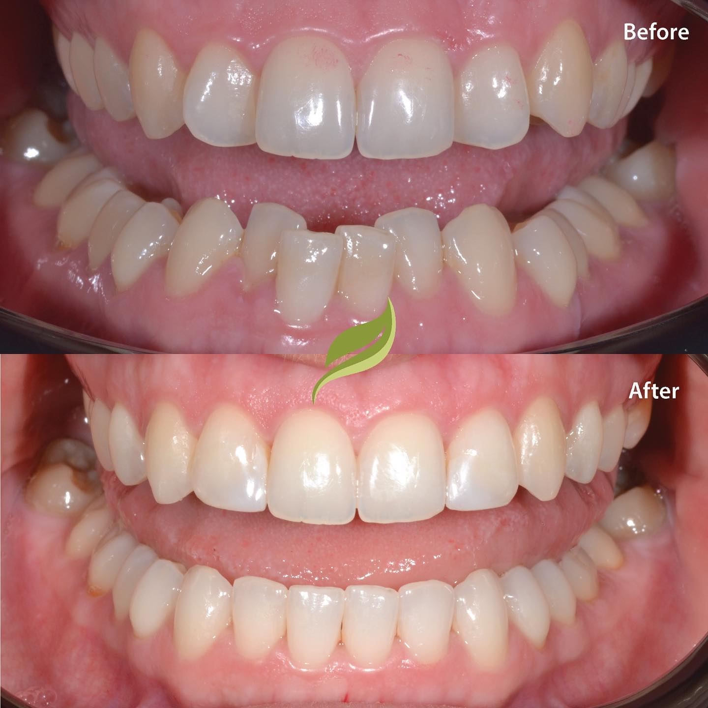 Teeth aligned with Invisalign followed by bleaching. To book your free aligner consultation DM us or contact the surgery 🦷 
#holmfirth #smilegoals #teethwhitening #perfectsmile #smilemakeover #cosmetic #dentist