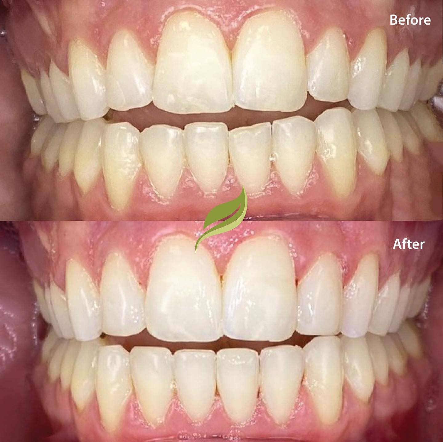 Composite Bonding 🦷

The technique of layering white filling over the natural teeth without preparation has helped this patient achieve a lengthened and straighter smile.

This can be used in combination with whitening and clear aligners. Contact us for a consultation ✨

#dentist #composite #compositebonding #clearaligners #teeth #smile #whitening