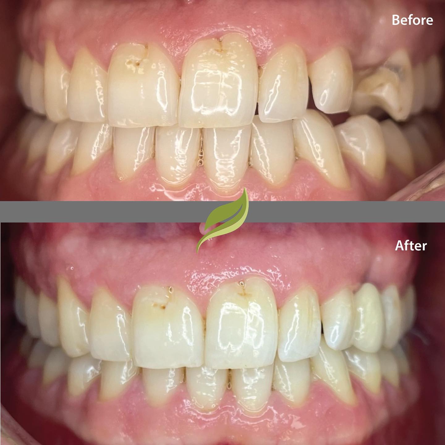Replacing teeth- this patient desperately wanted to close a gap for his wedding.
This bridge is a false tooth that is glued to the natural tooth next door which sometimes doesn’t even need injections.  Discuss options to replace your missing teeth - give the practice a ring or DM us on our website