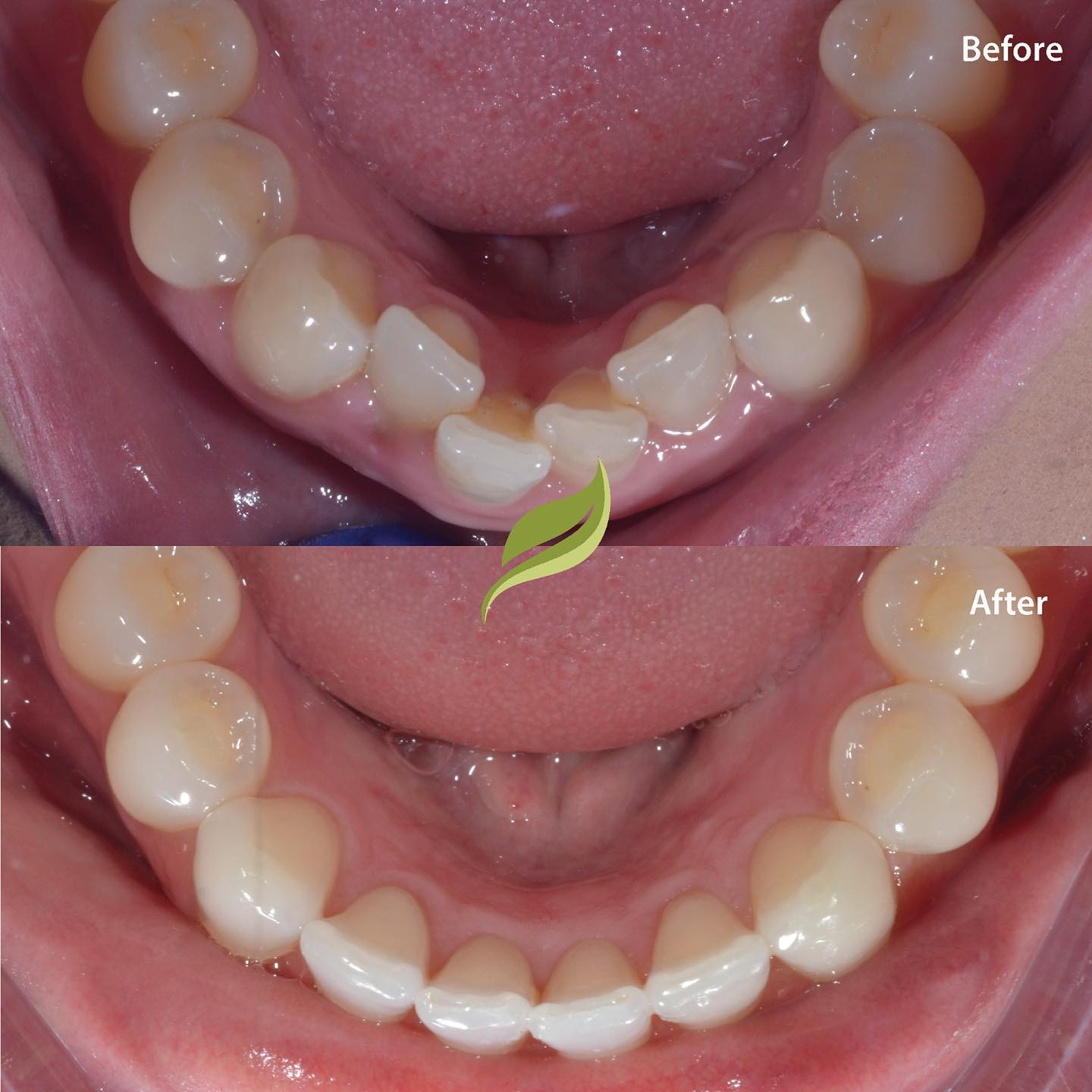 Another happy patient, all treatment within a year. We have different aligner systems to fit your straightening needs. Contact the practice today through our website if you’re interested 
#32co #invisalign #holmfirth