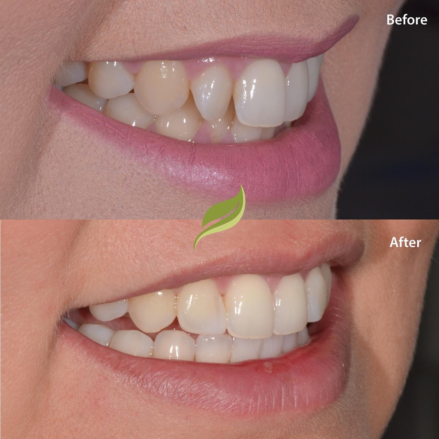 This patient was unhappy with her twisted tooth.
Teeth were aligned, bleached and finished off with minor composite bonding !
To book your free consultation .. either DM through our website or give us a ring #invisalign #compositebonding #holmfirth