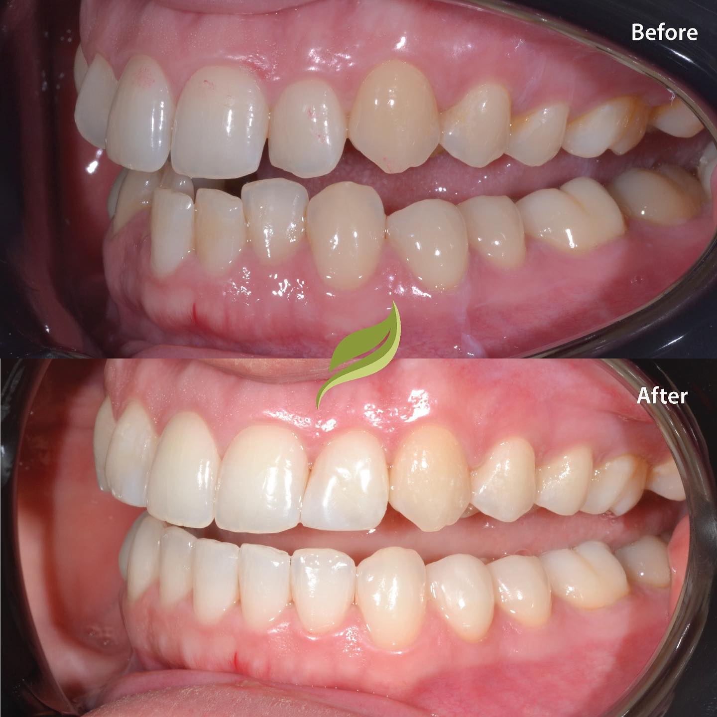 This patient wanted straighter teeth. Aligners, bleaching and minor composite bonding led to this transformation. DM the practice through our website or give us a ring  #holmfirth #aligners #compositebonding