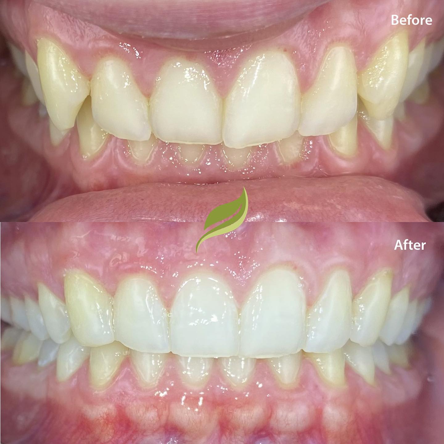 It’s as easy as ABC- Alignment, Bleaching, Composite! 
A beautiful smile, DM us / ring the surgery to contact us about your smile makeover 🦷#dentist #aligners #smiledesign #smilemakeover #holmfirth