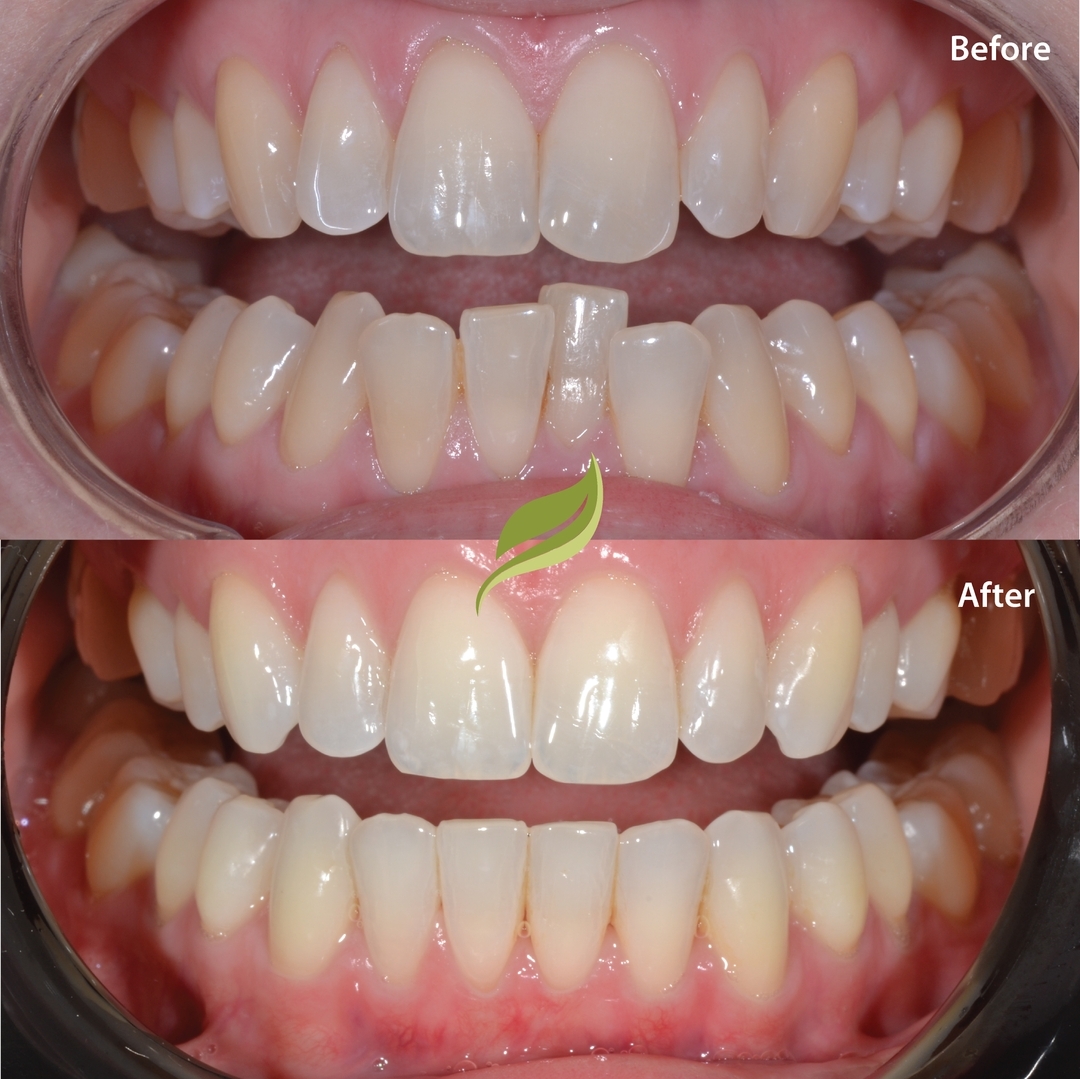 #veneers #invisalign #compositebonding #holmfirth