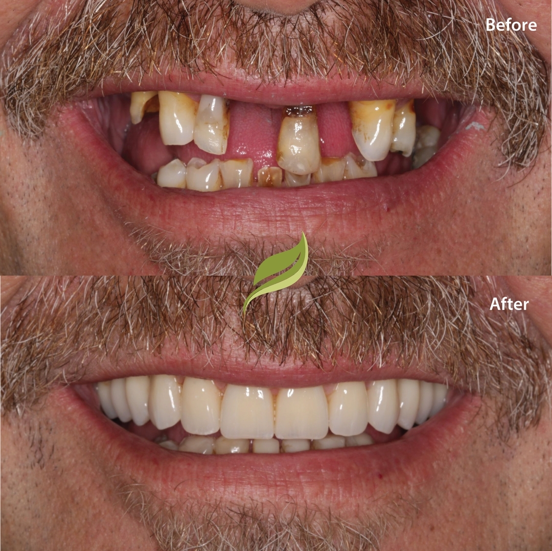 Embarking on a journey of renewed smiles and confidence. This patient took a brave step towards change. ⁣Failing teeth were gently replaced with implants, and by the end of the same day, a beautiful smile emerged. 
It's not just about fixing teeth; it's about caring for each patient's unique story and restoring their confidence to embrace life fully. 
#dentalimplants #samedaysmile #fullarchimplants #holmfirth