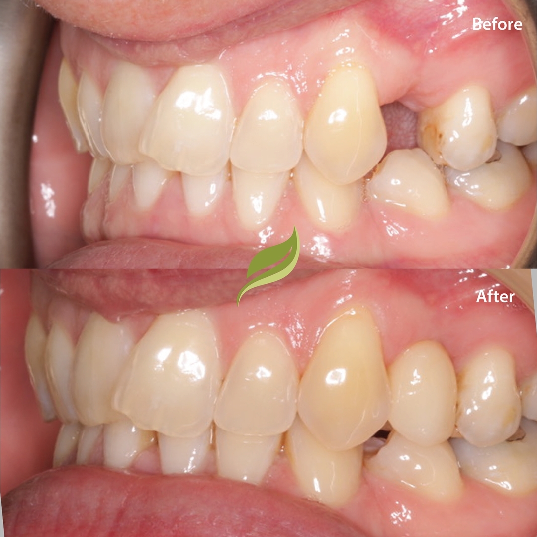 Today marks another step in our journey to restoring smiles and confidence. 
By restoring functionality and aesthetics, it allows patients to eat, speak, and smile with ease, enhancing their overall quality of life.
Here's to spreading happiness, one smile at a time! 
😁🦷​​​​​​​​​​​​​​​​​​​​​​​​​​​​​​​​
#dentlaimplants #invisalign #compositebonding #holmfirth