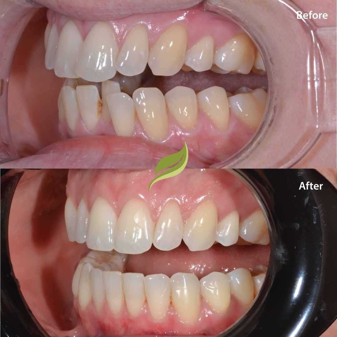 #holmfirthdentist #invisalign #holmfirth