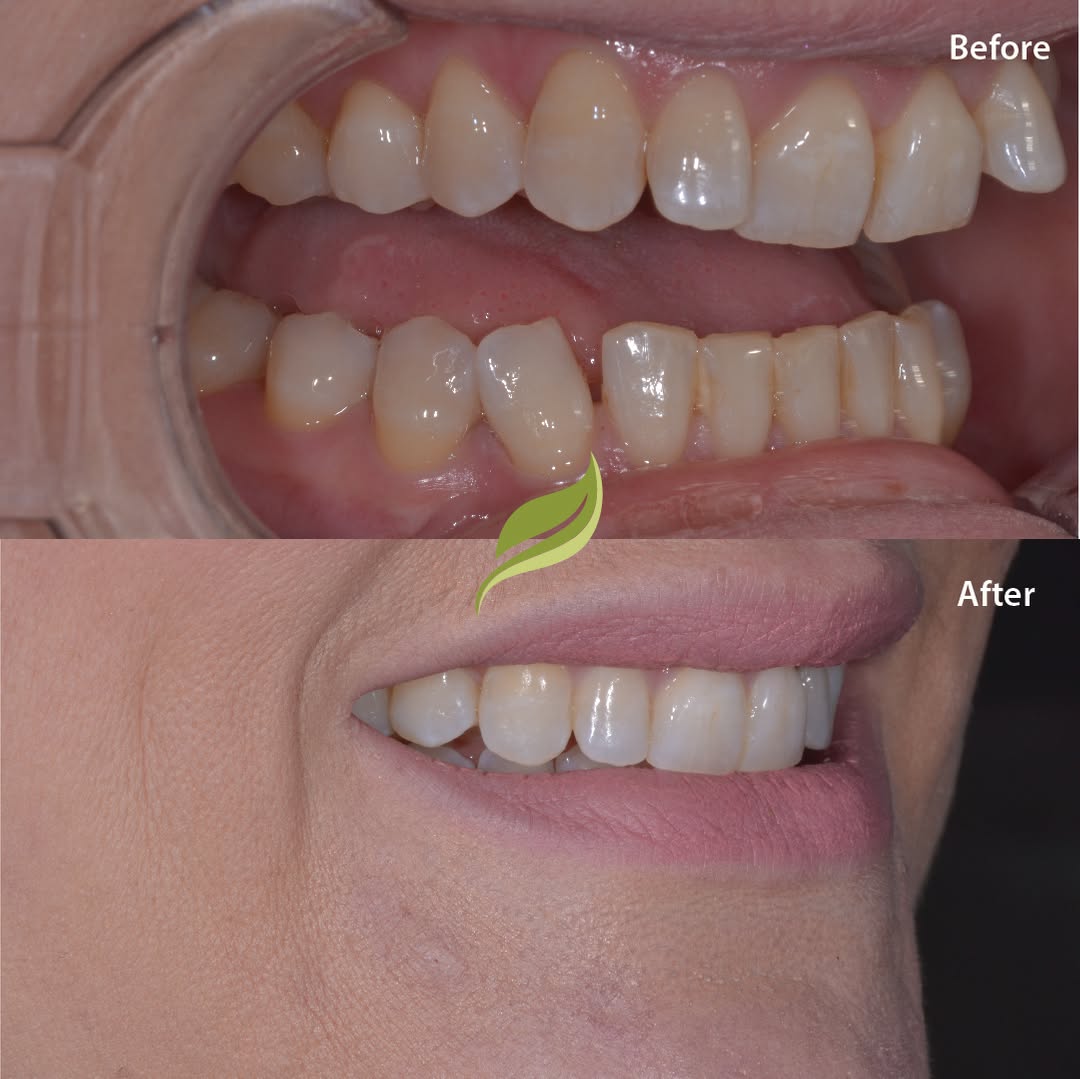 This patient was unhappy with the protruding lateral incisors and tipped back central incisors.​​​​​​​​​​​​​​​​
Teeth were aligned using Invisalign, finishing off with teeth whitening and minor composite edge bonding...for the perfect smile aesthetic!​​​​​​​​​​​​​​​​
To book your free Invisalign consultation ...DM us or follow the links in our bio!​​​​​​​​​​​​​​​​
😁🦷 ​​​​​​​​​​​​​​​​
​​​​​​​​​​​​​​​​
#veneers #invisalign #compositebonding #holmfirth
