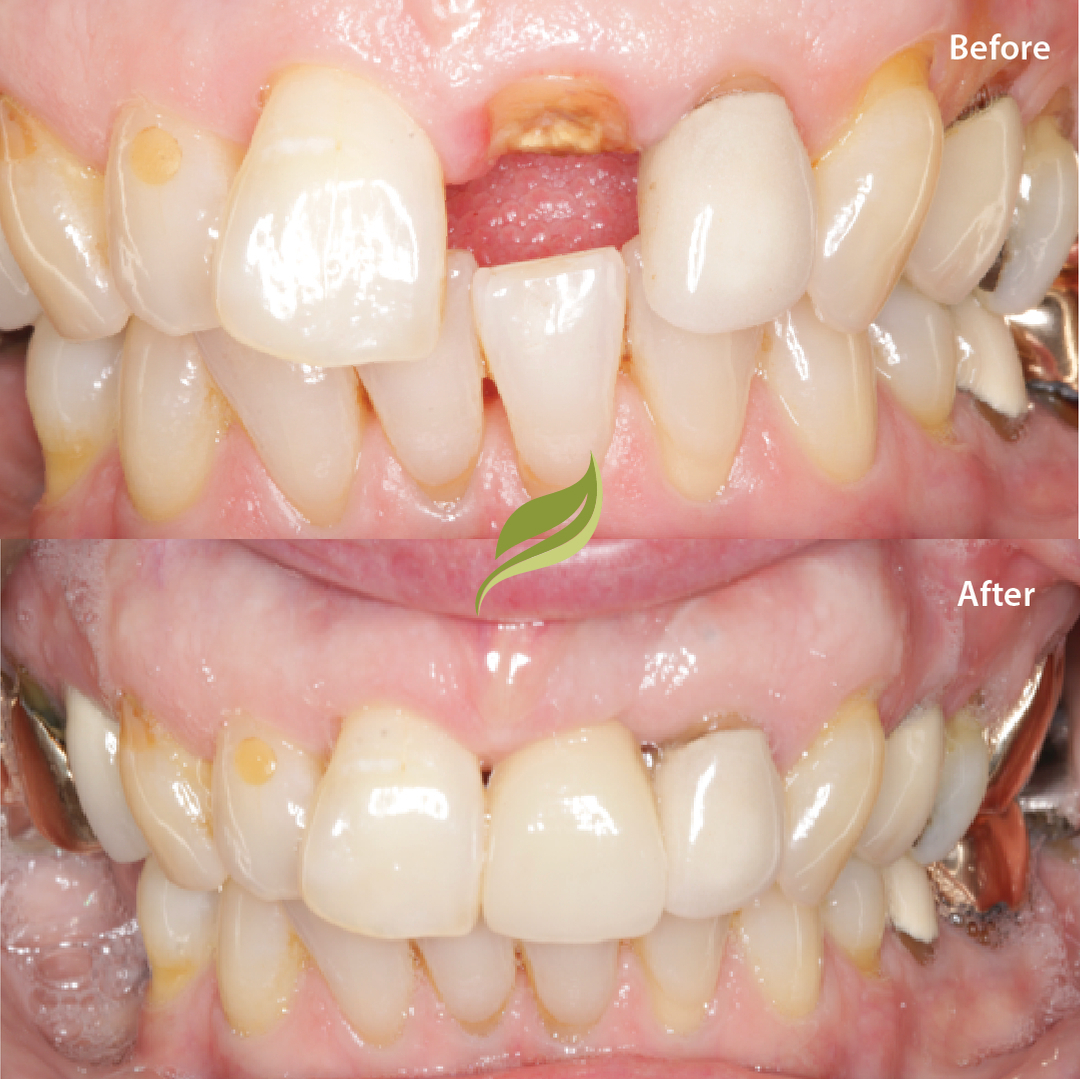 Dental Implants are a great option to replace fractured or missing teeth. ​​​​​​​​
To book your consultation ...DM us or follow the links in our bio!​​​​​​​​​​​​​​​​
😁🦷 ​​​​​​​​​​​​​​​​
​​​​​​​​​​​​​​​​
#dentalimplants #invisalign #compositebonding #holmfirth